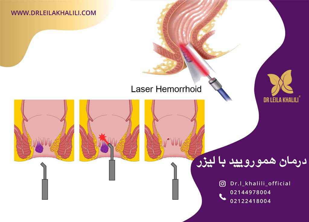درمان هموروئید با لیزر
